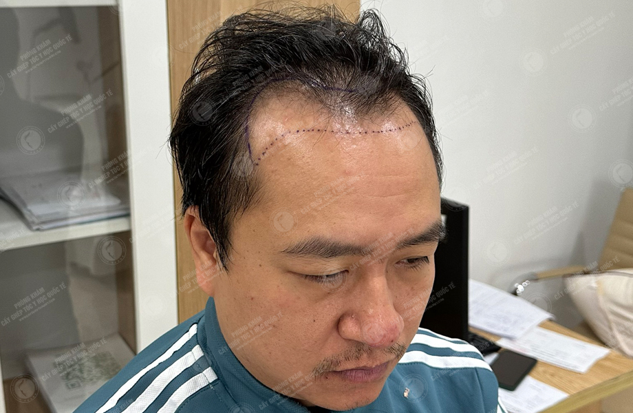 Trần Việt Hoàng - Cấy tóc đường chữ M 3
