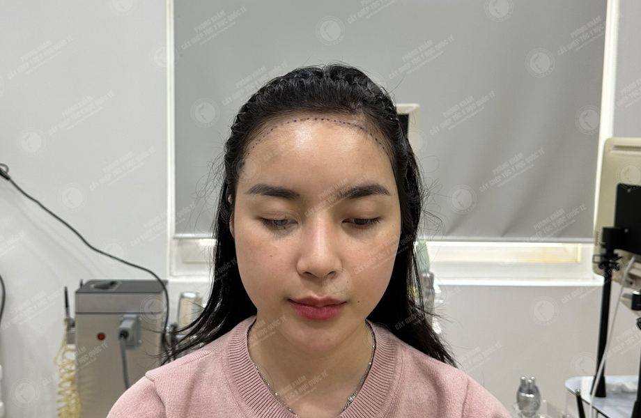 Nguyễn Hoàng Phương - Cấy tóc đường chữ M 3