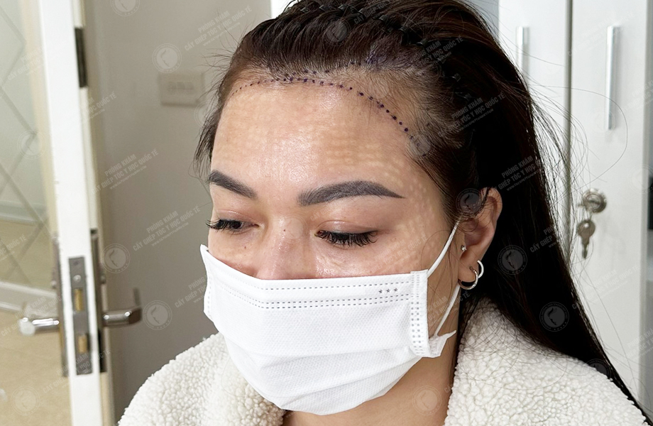 Nguyễn Thi Vân - Cấy tóc đường chữ M 3
