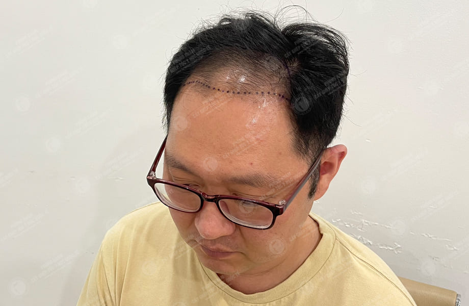 Han Seongmin - Cấy tóc đường chữ M 3