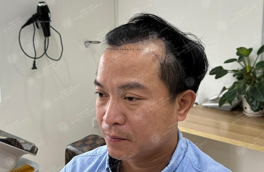 Nguyễn Khoa Tường - Cấy tóc đường chữ M 3