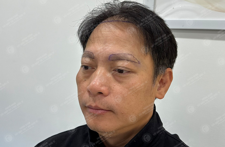 Trần Vinh Sơn - Cấy lông mày 3