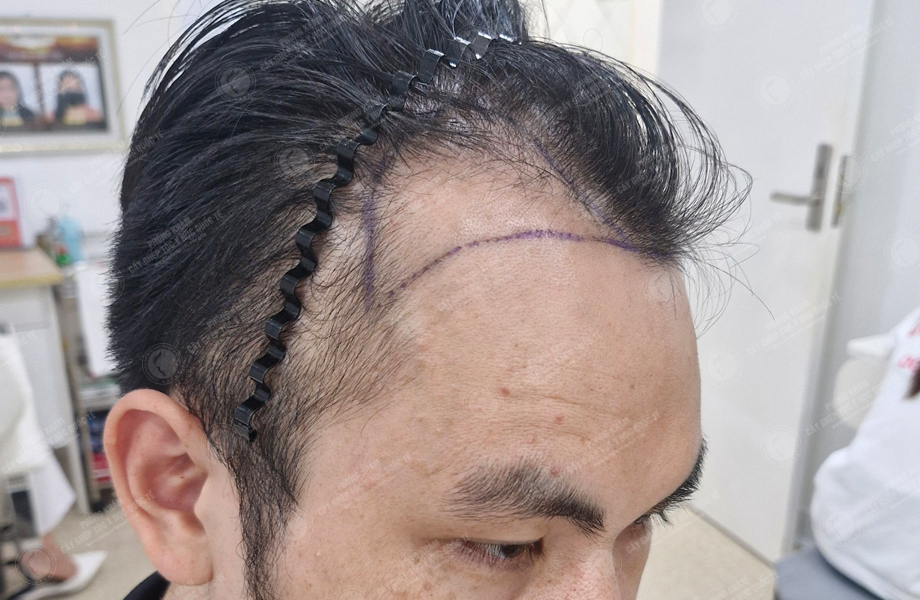 Đỗ Tùng Sang - Cấy tóc đường chữ M 3