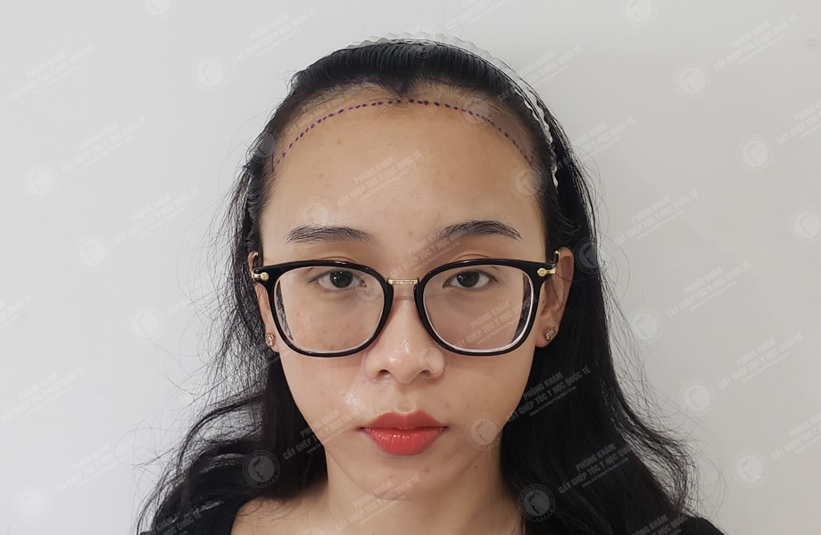 Hoàng Hồng Yến - Cấy tóc đường chữ M 3