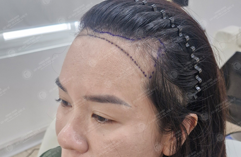 Đinh Thu Hương - Cấy tóc đường chữ M 3