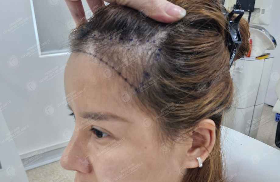 Cù Lệ Quyên - Cấy tóc đường chữ M 3