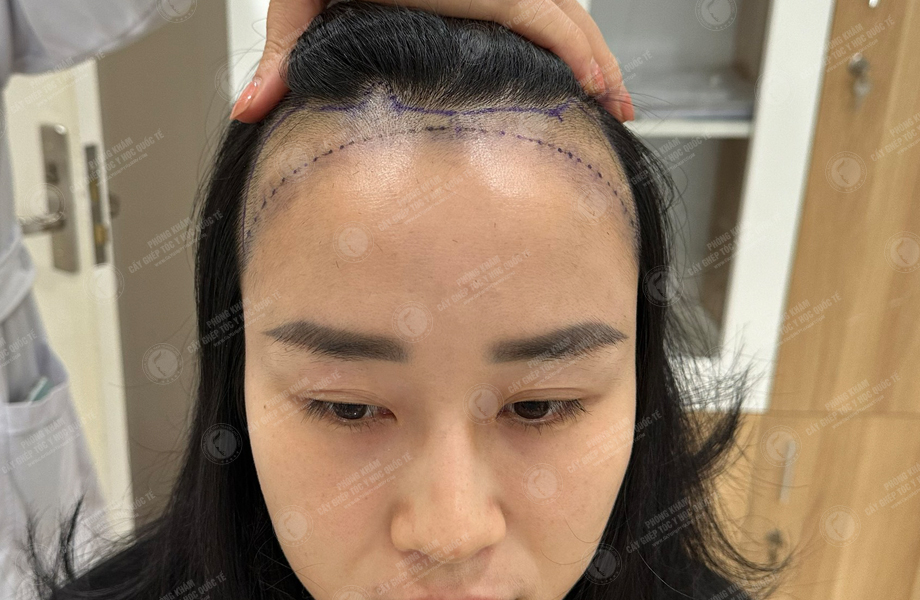 Nguyễn Thanh Hoa - Cấy tóc đường chữ M 3