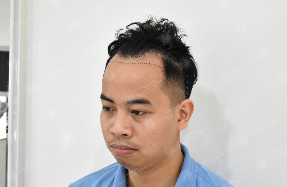 Lý Tùng Thanh - Cấy tóc đường chữ M 3