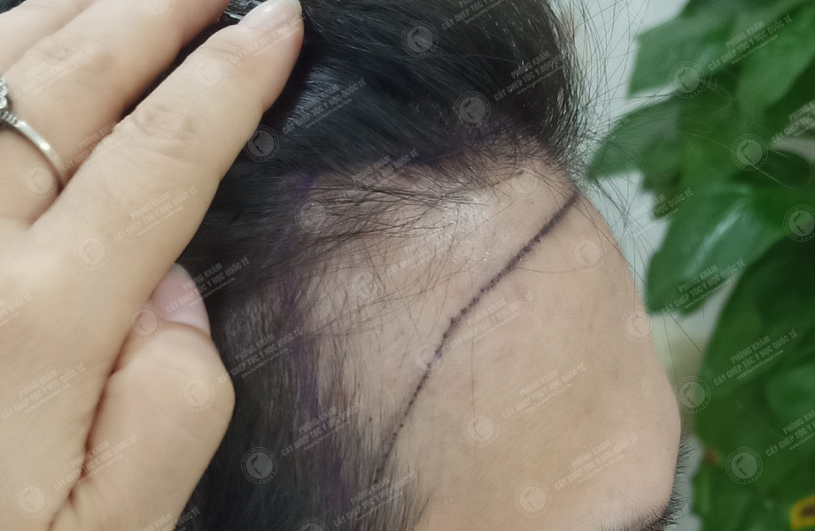 Nguyễn Hoàng Phi - Cấy tóc đường chữ M 3