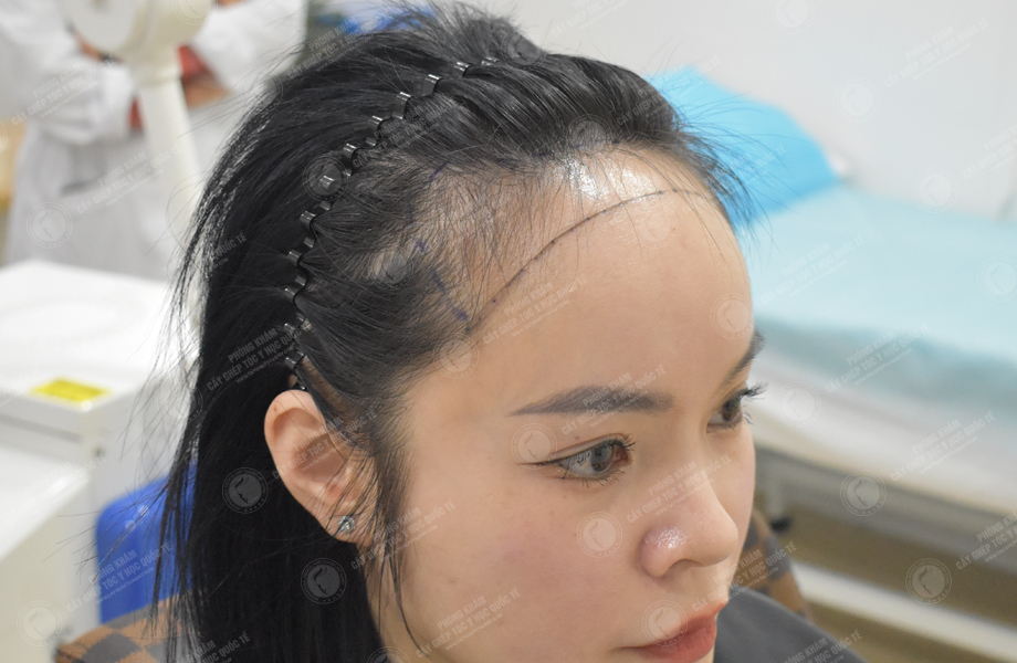 Phạm Thu Huyền - Cấy tóc đường chữ M 3
