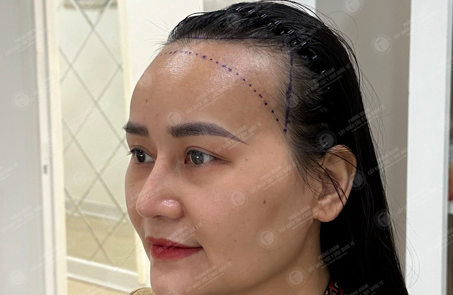Đỗ Thị Thu Trang - Cấy tóc đường chữ M 3