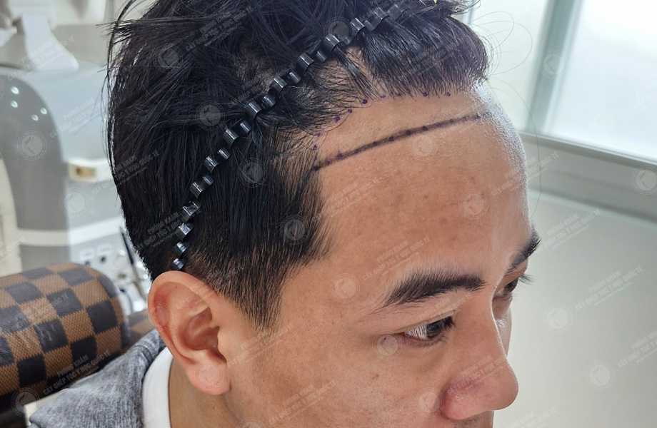 Lã Duy Thanh - Cấy tóc đường chữ M 3