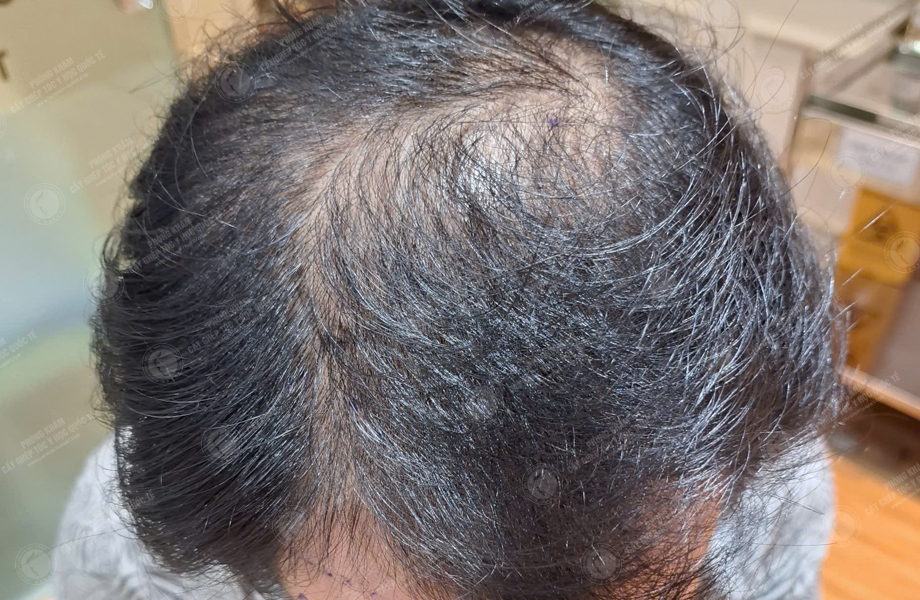 Dương Văn Tiến - Cấy tóc đường chữ M 3