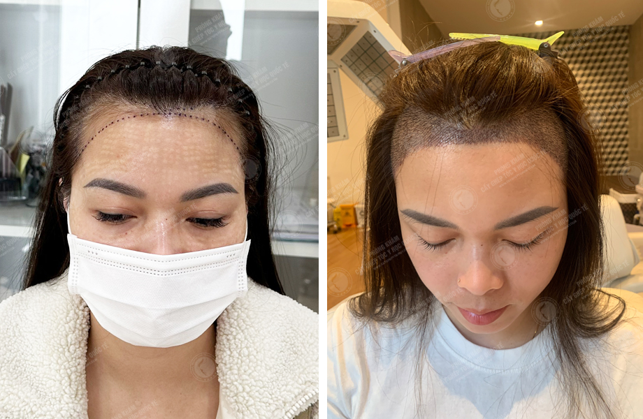  Nguyễn Thi Vân - Cấy tóc đường chữ M 1