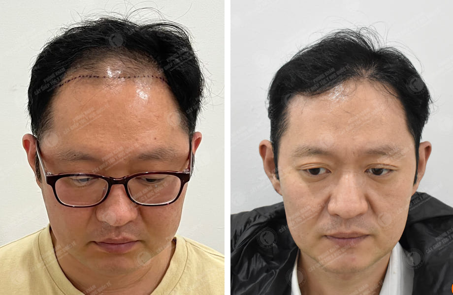  Han Seongmin - Cấy tóc đường chữ M 1