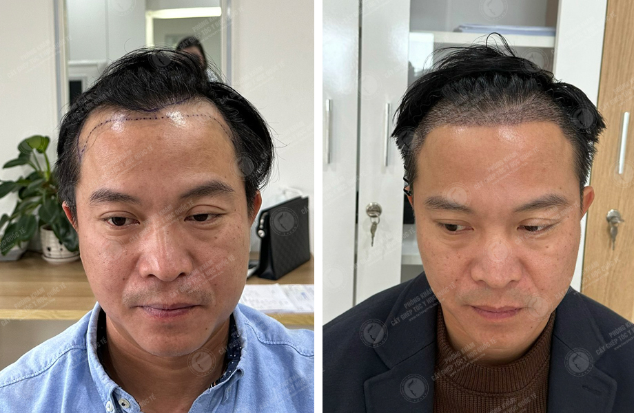  Nguyễn Khoa Tường - Cấy tóc đường chữ M 1