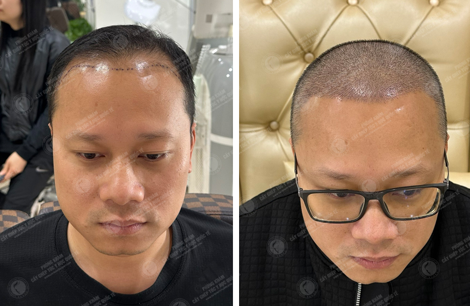  Nguyễn Chí Linh - Cấy tóc đường chữ M 1