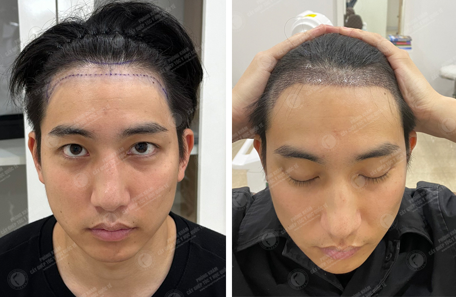  Nguyễn Sỹ Long - Cấy tóc tự thân 1