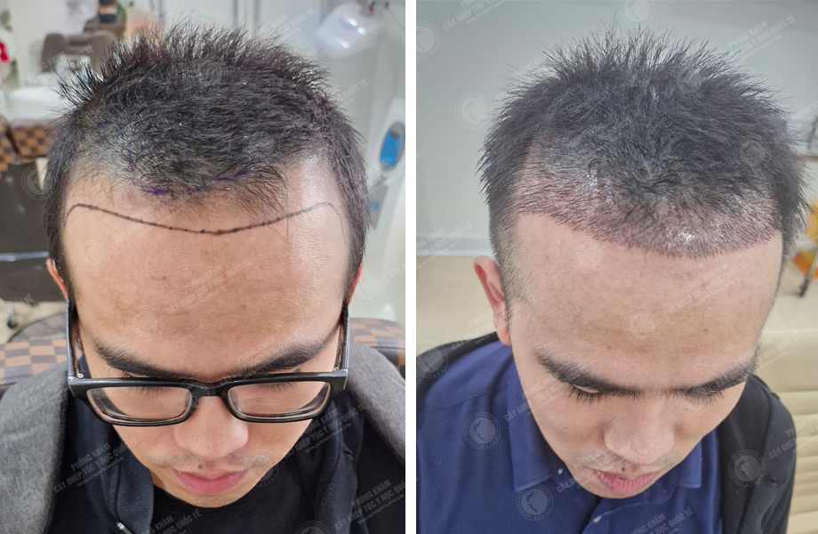  Trần Trung Sơn - Cấy tóc tự thân 1
