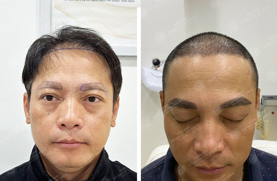  Trần Vinh Sơn - Cấy tóc tự thân 1