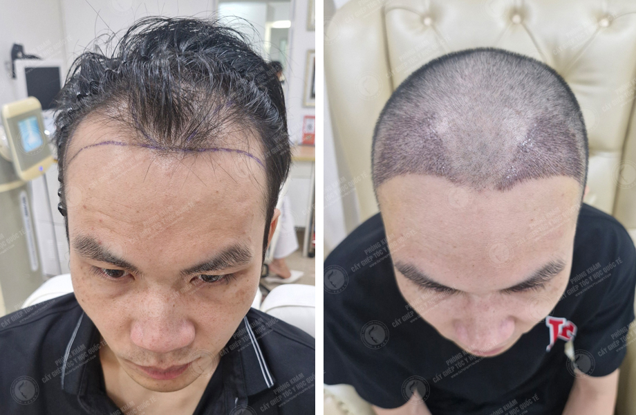  Đỗ Tùng Sang - Cấy tóc tự thân 1