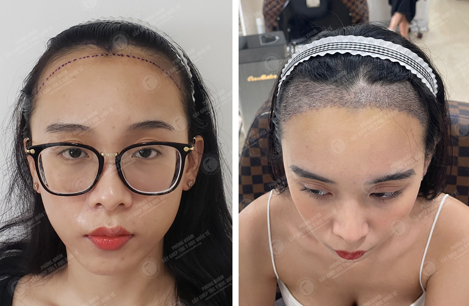 Hoàng Hồng Yến - Cấy tóc đường chữ M 1