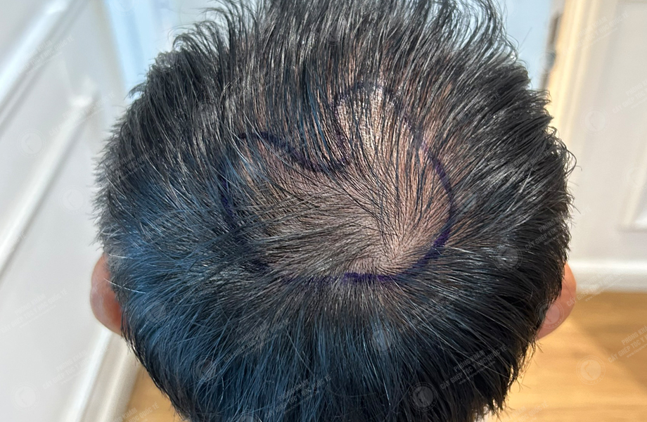 Nguyễn Hữu Huân - Cấy tóc đường chữ M 4