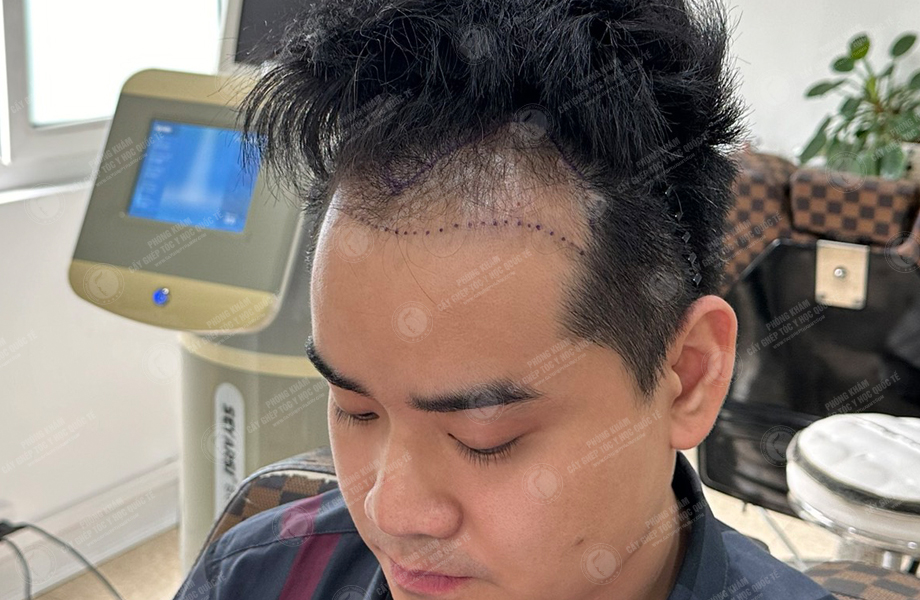 Vi Văn Tam - Cấy tóc đường chữ M 4
