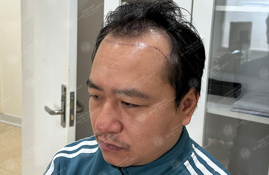 Trần Việt Hoàng - Cấy tóc đường chữ M 4