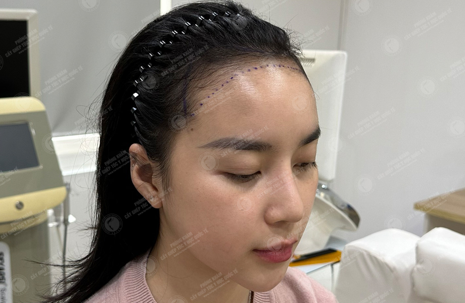 Nguyễn Hoàng Phương - Cấy tóc đường chữ M 4