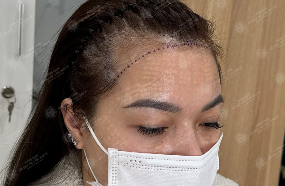 Nguyễn Thi Vân - Cấy tóc đường chữ M 4
