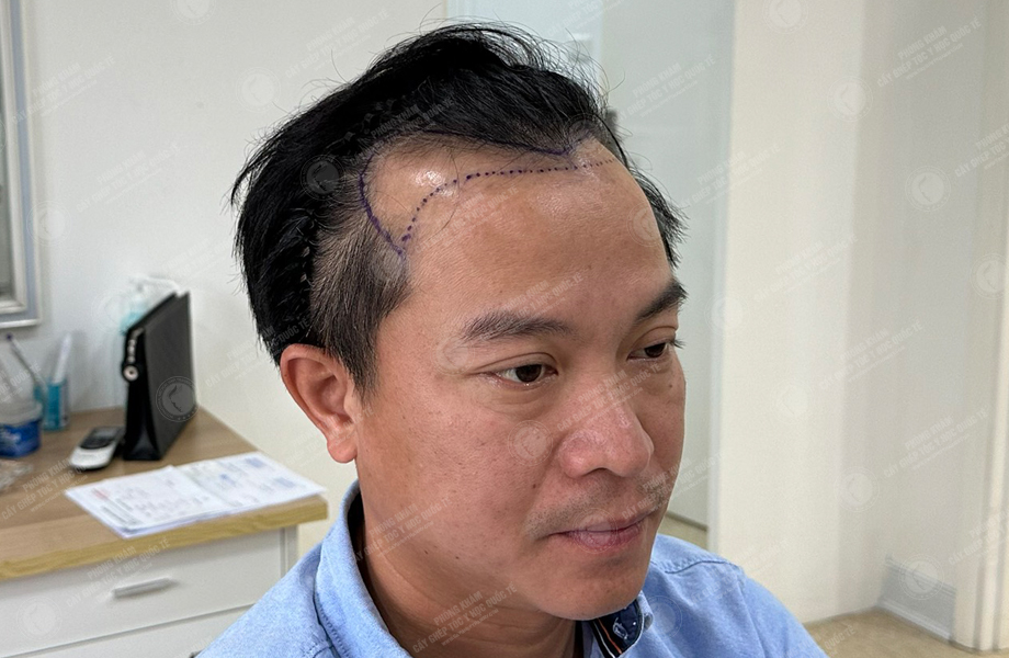 Nguyễn Khoa Tường - Cấy tóc đường chữ M 4