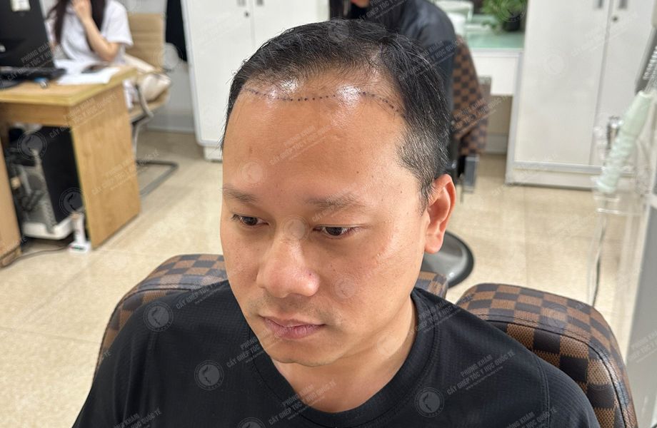 Nguyễn Chí Linh - Cấy tóc đường chữ M 4