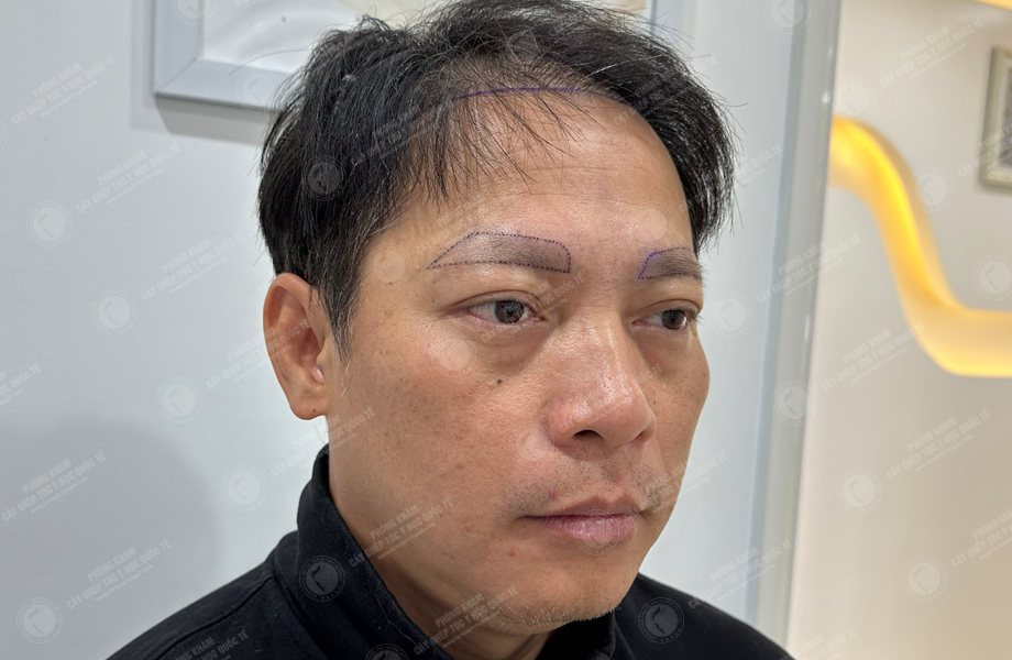 Trần Vinh Sơn - Cấy lông mày 4