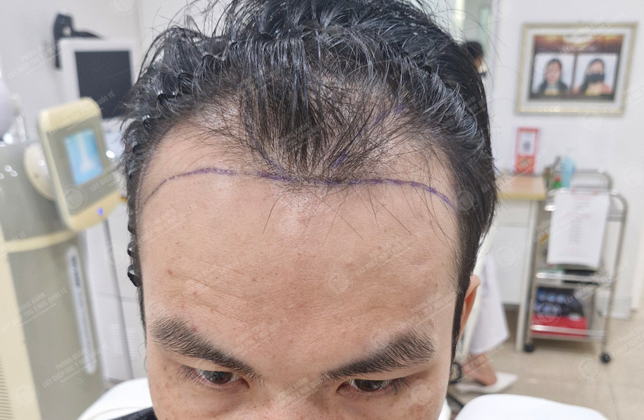 Đỗ Tùng Sang - Cấy tóc đường chữ M 4