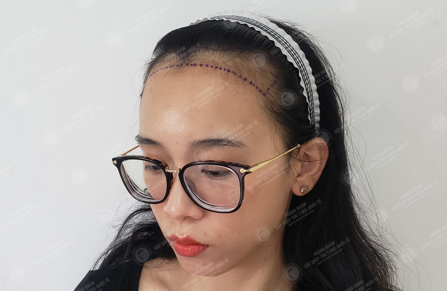 Hoàng Hồng Yến - Cấy tóc đường chữ M 4