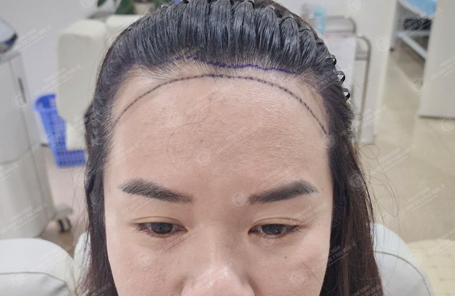 Đinh Thu Hương - Cấy tóc đường chữ M 4