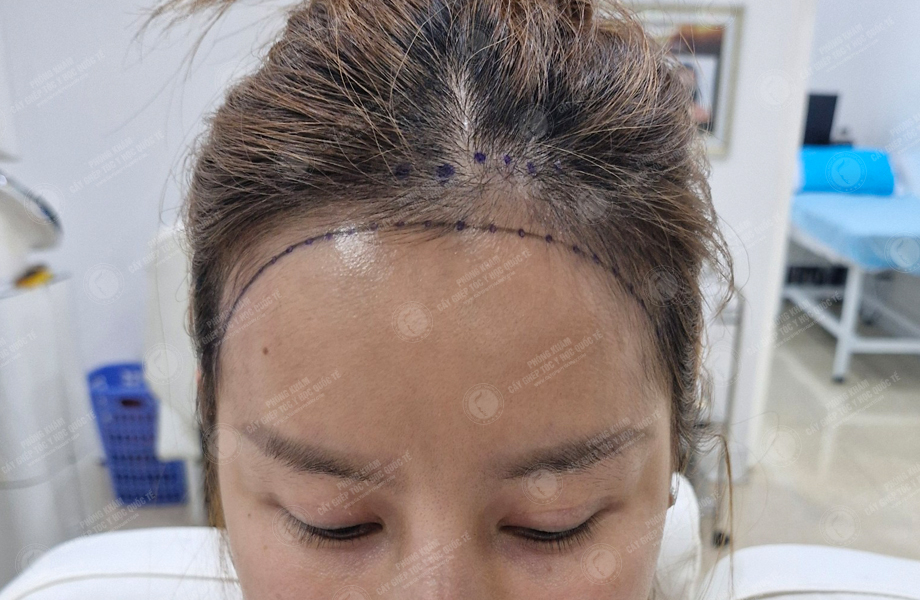 Cù Lệ Quyên - Cấy tóc đường chữ M 4