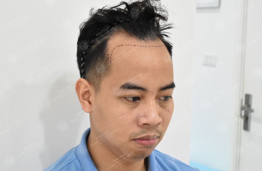 Lý Tùng Thanh - Cấy tóc đường chữ M 4