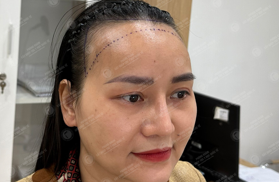 Đỗ Thị Thu Trang - Cấy tóc đường chữ M 4