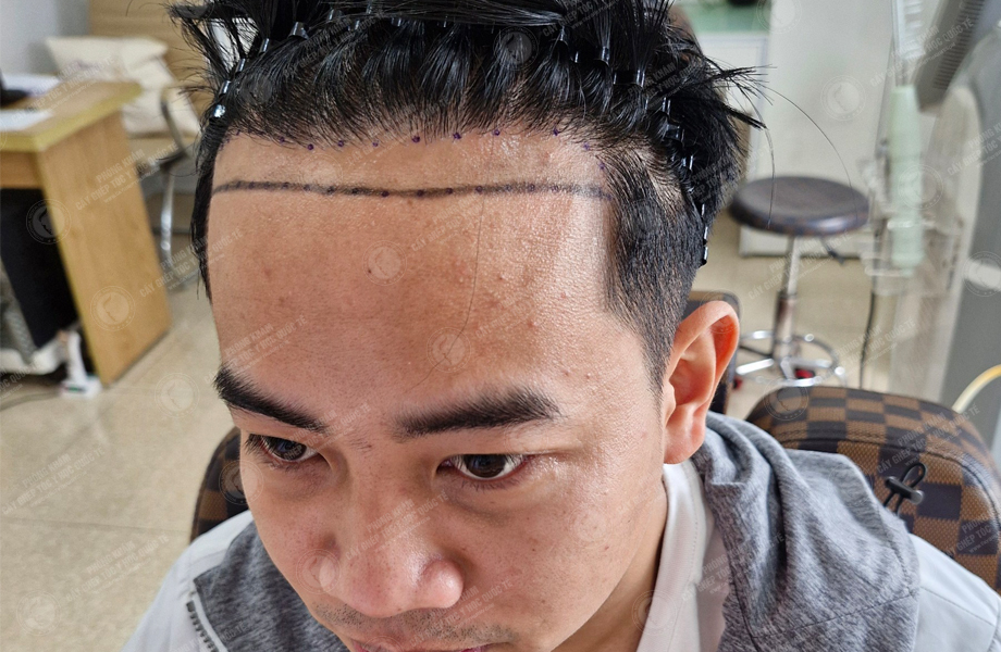 Lã Duy Thanh - Cấy tóc đường chữ M 4