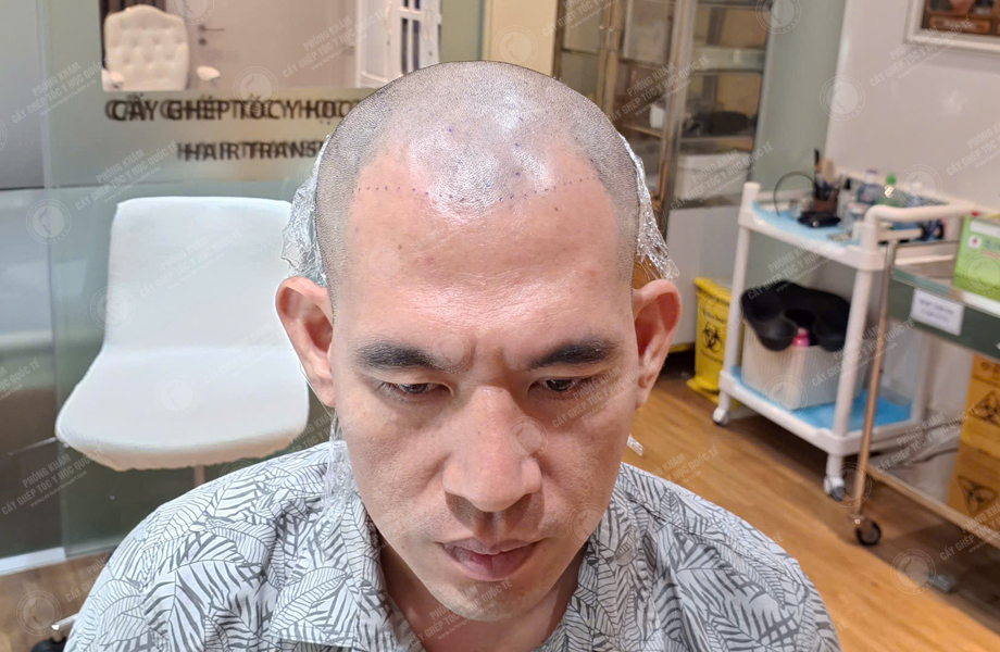 Dương Văn Tiến - Cấy tóc đường chữ M 4