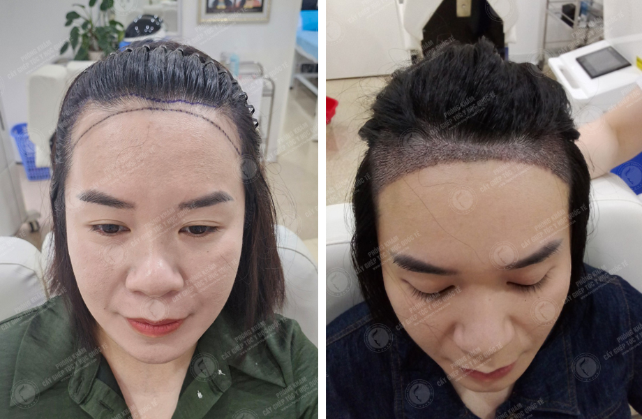  Đinh Thu Hương - Cấy tóc đường chữ M 1