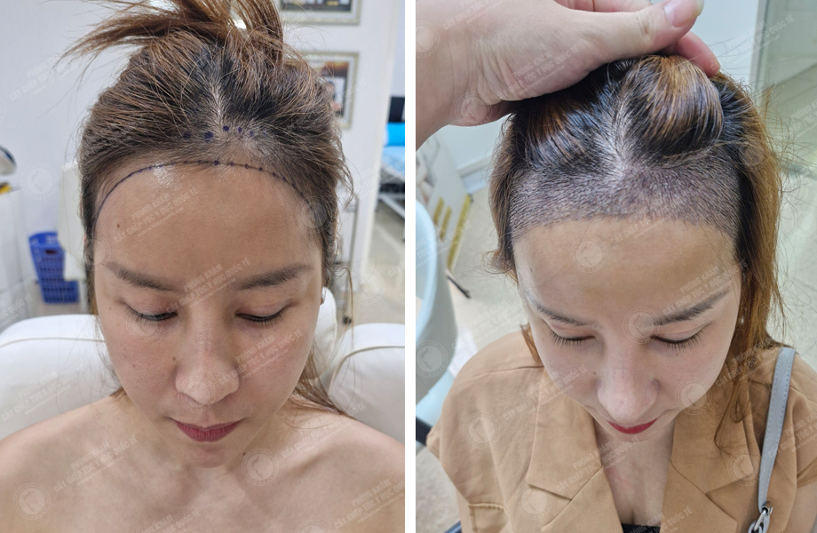  Cù Lệ Quyên - Cấy tóc đường chữ M 1