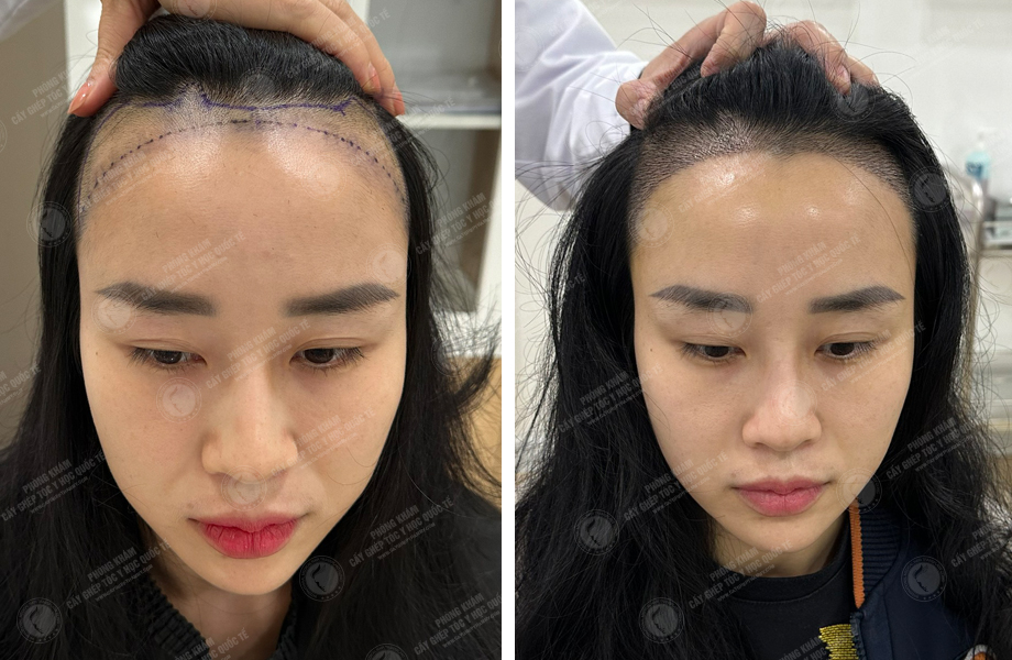  Nguyễn Thanh Hoa - Cấy tóc đường chữ M 1