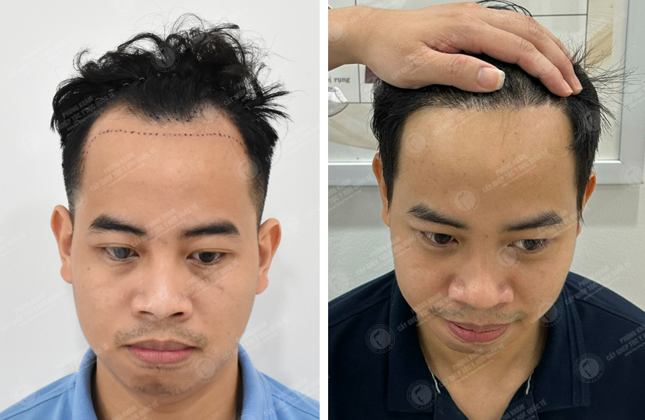  Lý Tùng Thanh - Cấy tóc đường chữ M 1