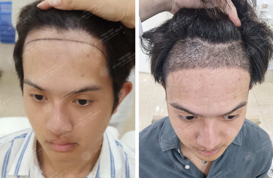  Nguyễn Hoàng Phi - Cấy tóc đường chữ M 1