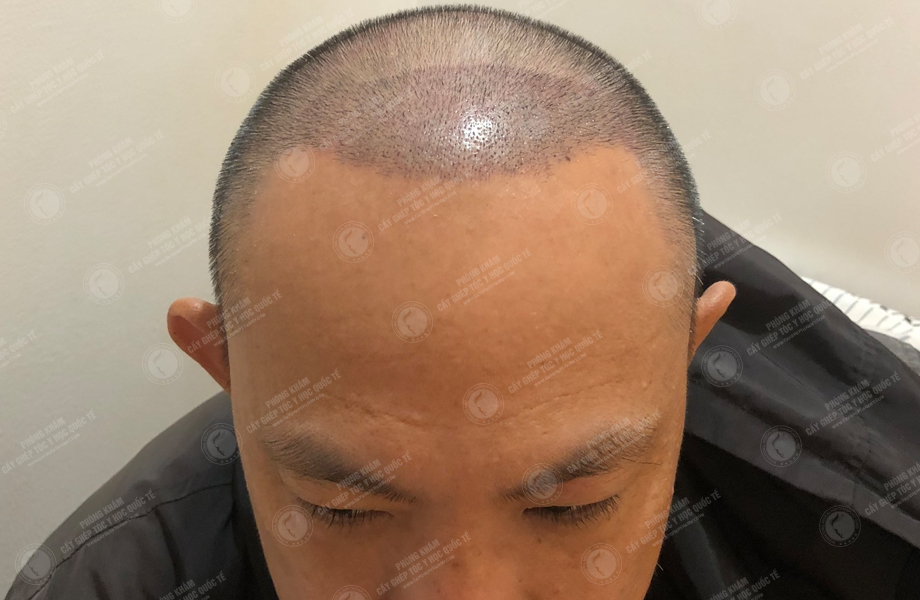 Nguyễn Hữu Huân - Cấy tóc đường chữ M 5