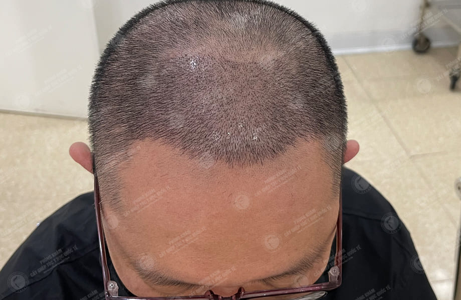 Han Seongmin - Cấy tóc đường chữ M 6