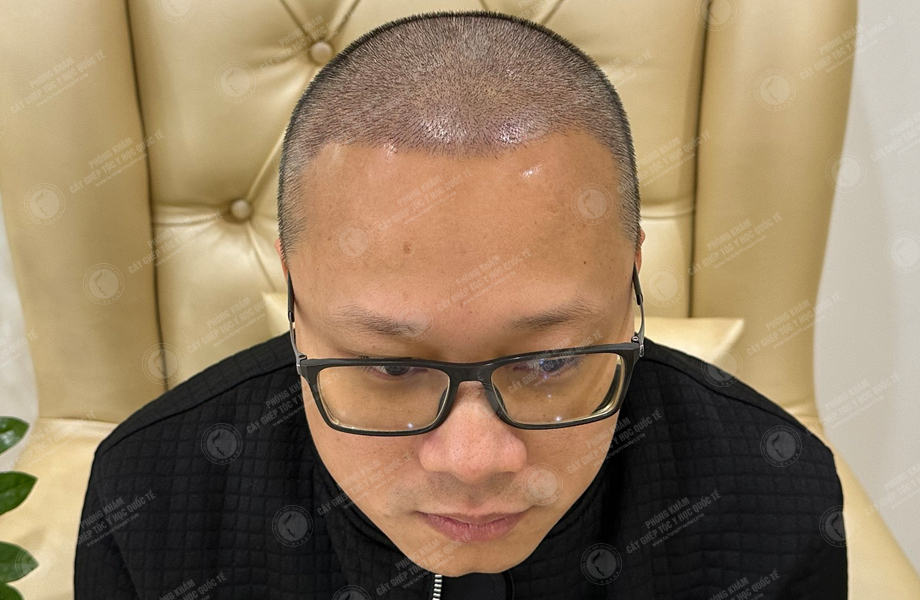 Nguyễn Chí Linh - Cấy tóc đường chữ M 5